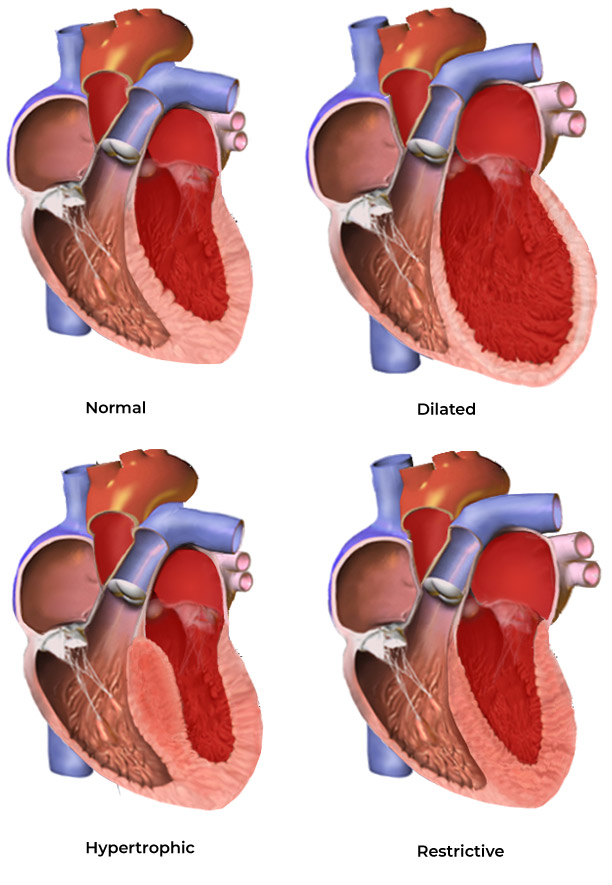 cardiomyopathy-types