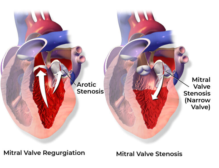 Heart Valve Diseases - Dr. KS Kishore